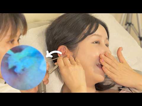Видео: ASMR👂🏻Удивительная эндоскопическая чистка ушей | Кошачья шерсть в ухе? | Путешествие Китай🇨🇳
