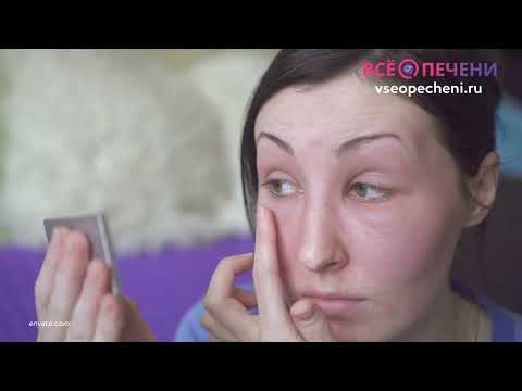 Видео: Рак печени. ВсёОпечениРу