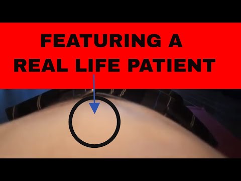 Видео: Упражнения при диастизе прямых мышц живота ДЛЯ МУЖЧИН