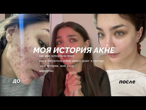 Видео: АКНЕКУТАН/ ВЫЛЕЧИЛА АКНЕ/ моя история лечения длиною в 8 лет / МНОГО ФОТО