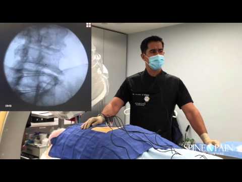 Видео: Радиочастотная абляция Процедура