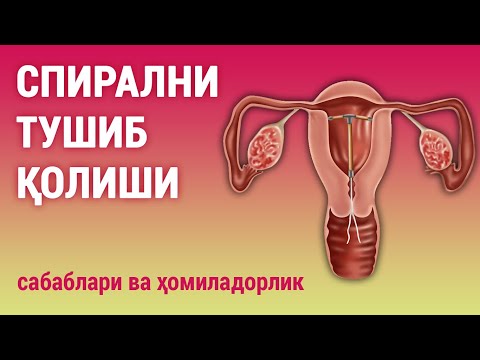Видео: Спирални тушиб қолиши: сабаблари ва ҳомиладорлик
