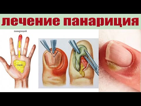 Видео: Как быстро вылечить панариций за 1 день. Нарывает палец.