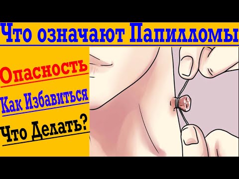 Видео: Настоящая причина Папиллом на теле ! Это ВАЖНО Знать !