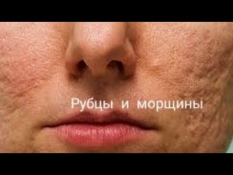 Видео: АПТЕЧНОЕ СРЕДСТВО. Чем убрать РУБЦЫ, ШРАМЫ, МОРЩИНЫ, РАСТЯЖКИ.