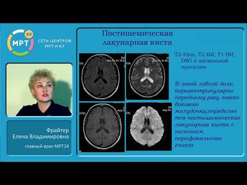 Видео: «Описание пациентов с нарушением мозгового кровообращения по ишемическому типу в разные периоды»