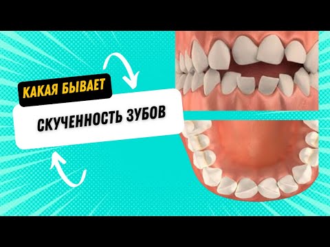 Видео: Скученность зубов 