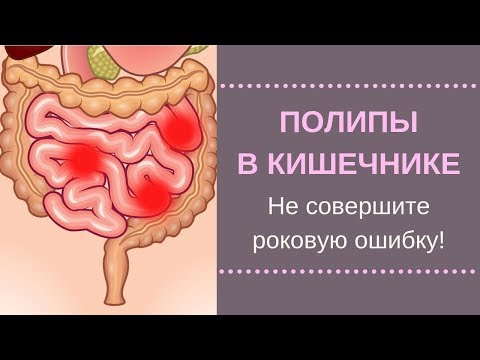 Видео: 🔥Полипы В Кишечнике. Нашли полипы при колоноскопии. Как не совершить ошибку