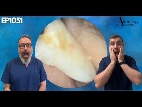 Видео: Огромный кусок кожи, удалённый из уха - EP1051