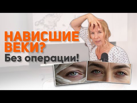 Видео: КАК УБРАТЬ НАВИСШИЕ ВЕКИ БЕЗ БЛЕФАРОПЛАСТИКИ