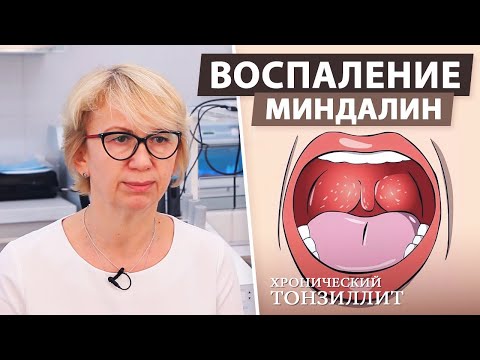 Видео: Страдаете хроническим тонзиллитом? Что можно сделать с воспалением миндалин