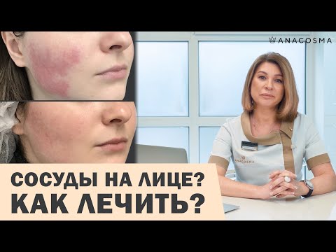 Видео: СОСУДЫ НА ЛИЦЕ: КУПЕРОЗ, РОЗАЦЕА ИЛИ ГЕМАНГИОМА 😱⛔️ КАК ЛЕЧИТЬ⁉️