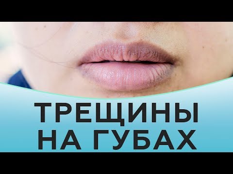 Видео: Трещины на губах. Как избавиться от трещин на губах
