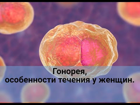 Видео: Гонорея, особенности течения у женщин