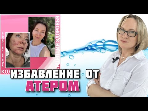 Видео: Молодая женщина избавилась от атером после долгих лет безуспешного лечения