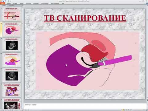 Видео: УЗИ малого таза женщин в норме Палёный А И
