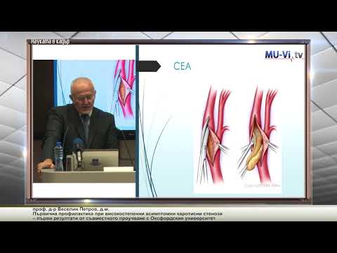 Видео: Първична профилактика при високостепенни асимптомни каротисни стенози
