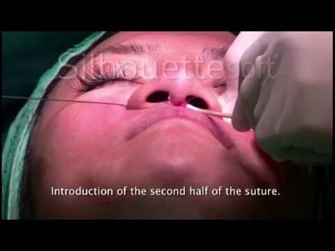 Видео: Коррекция спинки и крыльев носа конусными нитями Силуэт в Махачкале - 89882 919 969