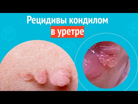 Видео: 😨 Рецидивы кондилом в уретре. Клинический случай №1547