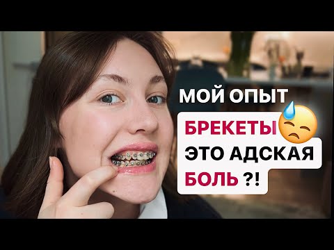 Видео: БРЕКЕТЫ — это больно?! МОЯ ИСТОРИЯ…