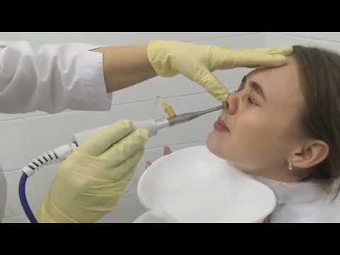 Видео: Орошение носоглотки на аппарате «Роса» в Екатеринбурге