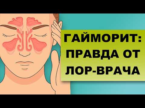 Видео: ГАЙМОРИТ - НЕ ПРОСТУДА! Как не запустить болезнь? Ошибки, о которых молчат!