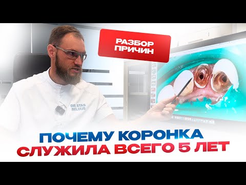 Видео: Почему коронка служила всего 5 лет, разбор ошибок. Стоматолог Стас Белоус, Ульяновск