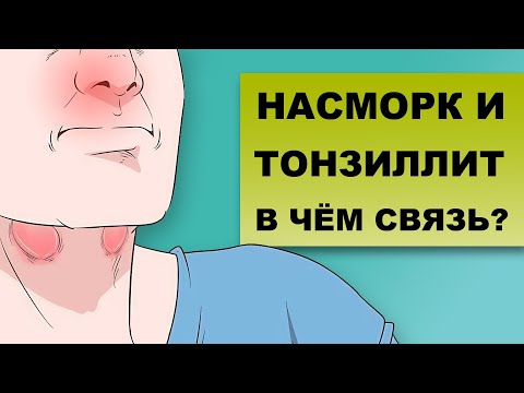 Видео: НАСМОРК, ГАСТРИТ, РЕФЛЮКС? Виноват тонзиллит!