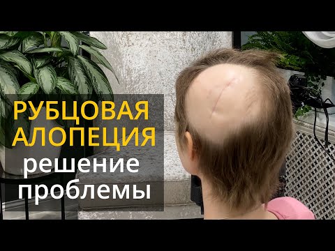 Видео: Рубцовая алопеция - решение проблемы есть! #системыволос