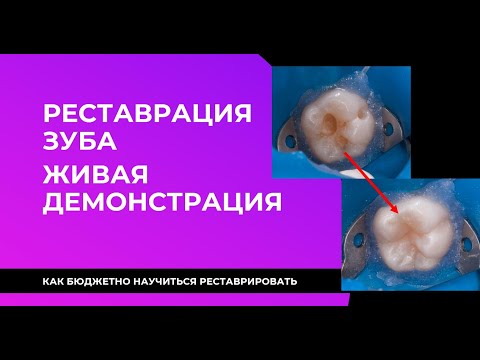 Видео: ПРЯМАЯ РЕСТАВРАЦИЯ ЗУБА ЖИВАЯ ДЕМОНСТРАЦИЯ