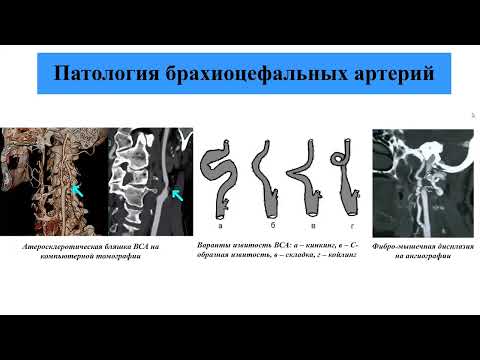 Видео: Павленко А.А. "Ультразвуковое исследование брахиоцефальных артерий" (Часть 1) 27.09.2023