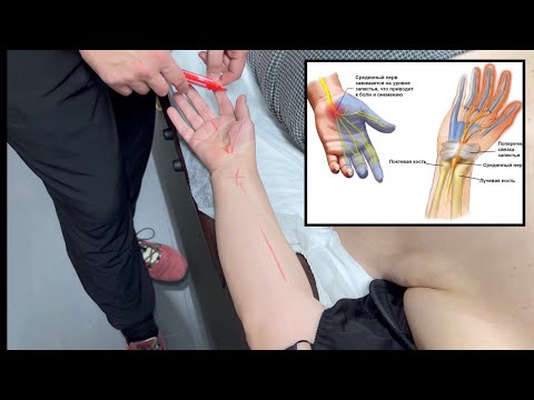 Видео: Немеют пальцы. Тянет рука. Где искать причину боли?! карпальный туннельный синдром