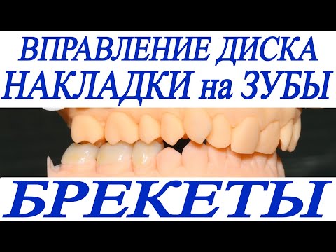 Видео: Щелкает сустав, скученность зубов, ортотик, накладки на зубы, брекеты, ортодонтическое лечение.
