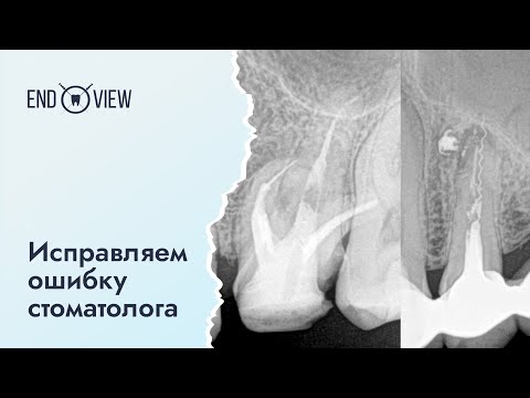 Видео: Инструмент в канале зуба - что делать?