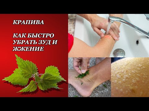 Видео: КАК БЫСТРО УБРАТЬ ЗУД И ЖЖЕНИЕ ПРИ ОЖОГЕ КРАПИВОЙ