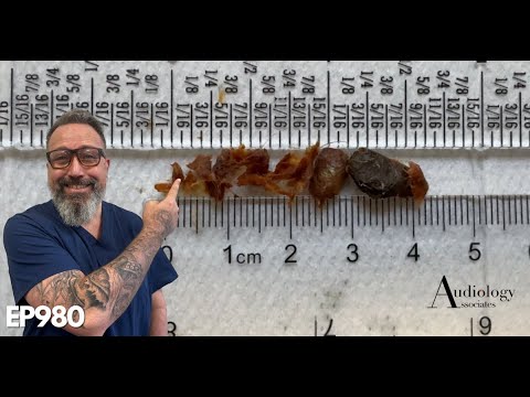 Видео: Почему 3 аудиолога не смогли удалить мне ушную серу? - EP980