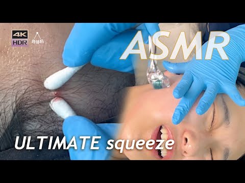 Видео: ASMR | $500 ULTIMATE Выдавить прыщ и корейский уход за кожей