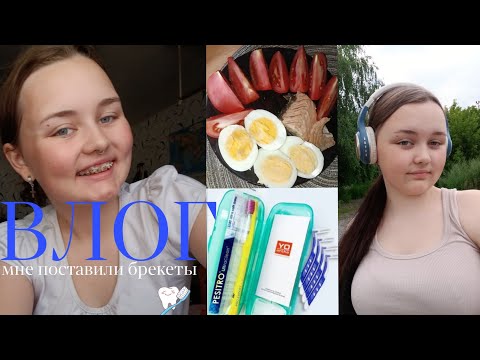 Видео: ВЛОГ/установка брекетов:первые ощущения,питание,стоимость