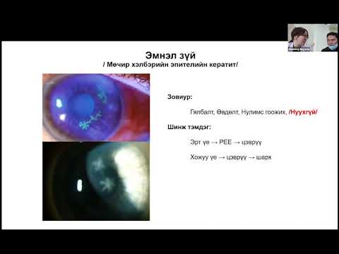 Видео: Илтгэл: Вирусын гаралтай эвэрлэгийн үрэвсэл