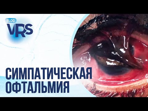 Видео: Травма глаза / Симпатическая офтальмия