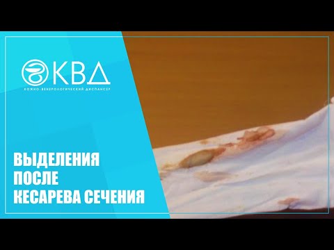 Видео: 👩 1473  Выделения после кесарева сечения