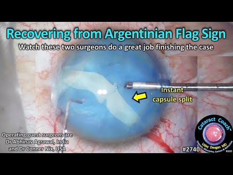 Видео: CataractCoach™ 2740: восстановление после знака аргентинского флага при набухающей белой катаракте