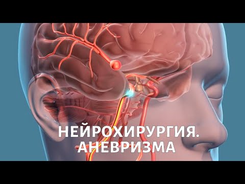Видео: Нейрохирургия: удаление аневризм. Медицина будущего