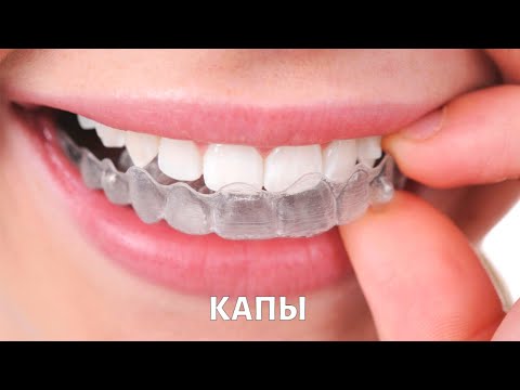 Видео: Капы для исправления прикуса: можно ли обойтись без брекетов?