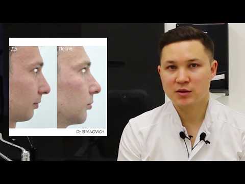 Видео: УВЕЛИЧЕНИЕ ПОДБОРОДКА / ФИЛЛЕР ГК / Dr Sitanovich
