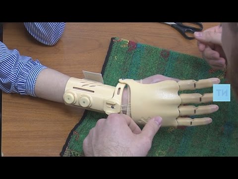 Видео: Потерявшей руку студентке из Челнов установили уникальный протез