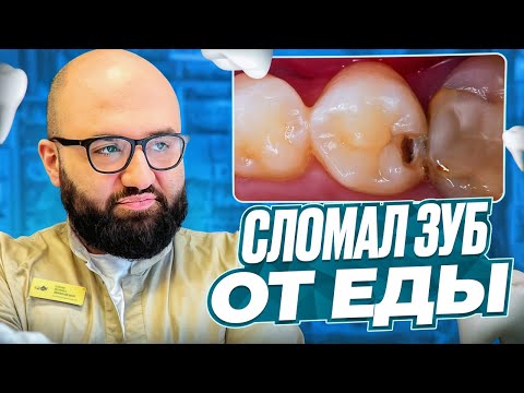 Видео: Сломался зуб из-за еды? Вылечили за 5 минут!