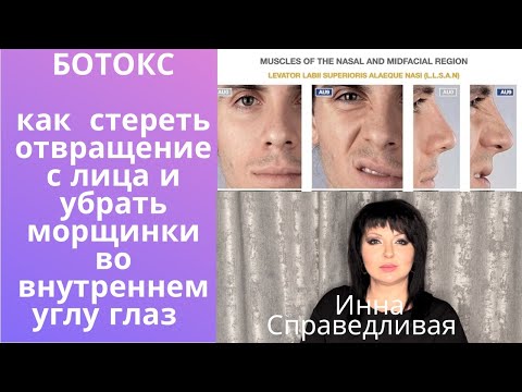 Видео: Как убрать презрительное выражение с лица и морщинки во внутреннем углу глаз!