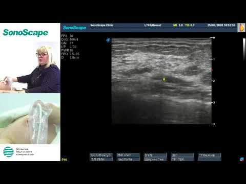 Видео: Мастер-класс на аппарате SonoScape S8Exp. Лектор: Заболотская Н.В.