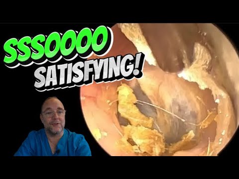 Видео: ТАК УДОВЛЕТВОРИТЕЛЬНО! 357#ухо #ушнаясера #удалениеушнойсеры #asmr #удовлетворительно #длявас #fy...